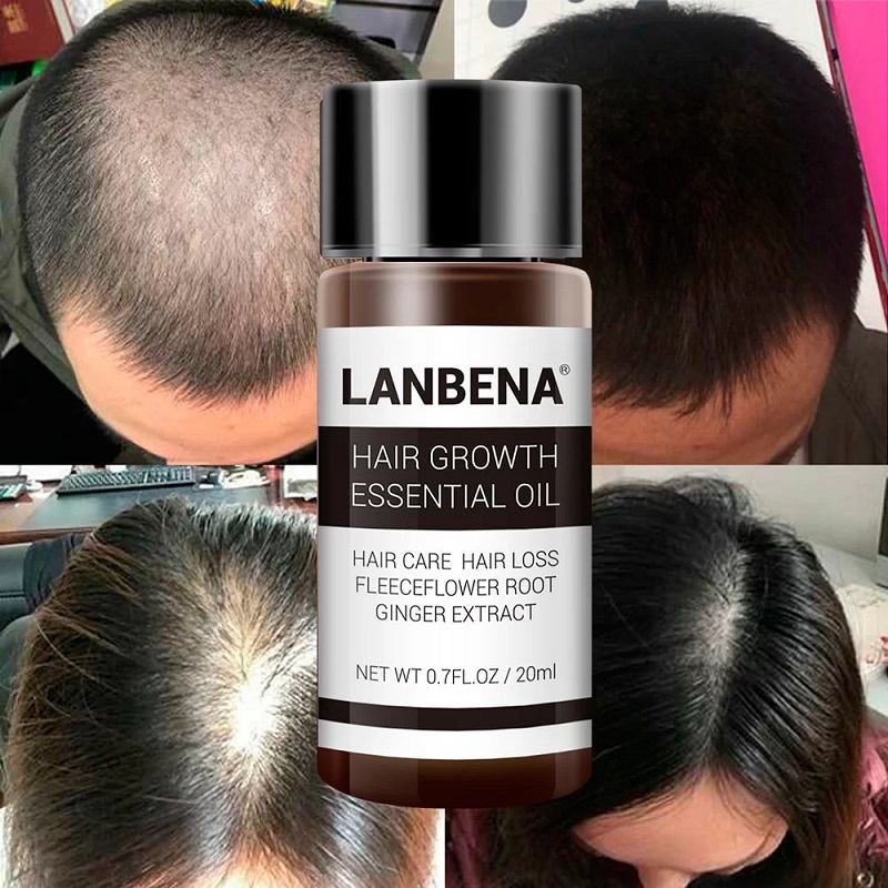 روغن رشد مو لانبنا LANBENA