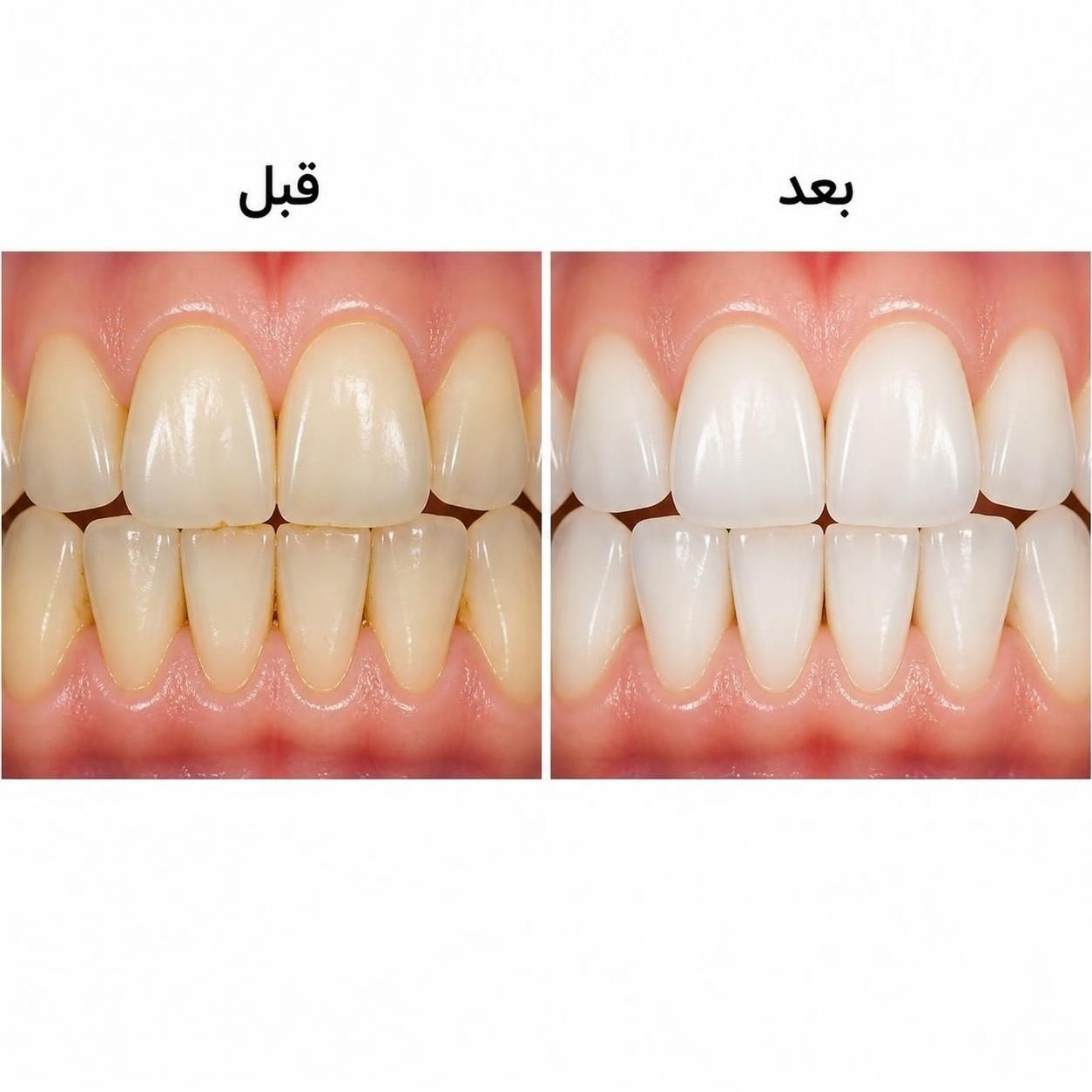 پکیج سرم سفید کننده دندان لانبنا مسواک برقی شیائومی مدل X3 قابل شارژ ضدآب